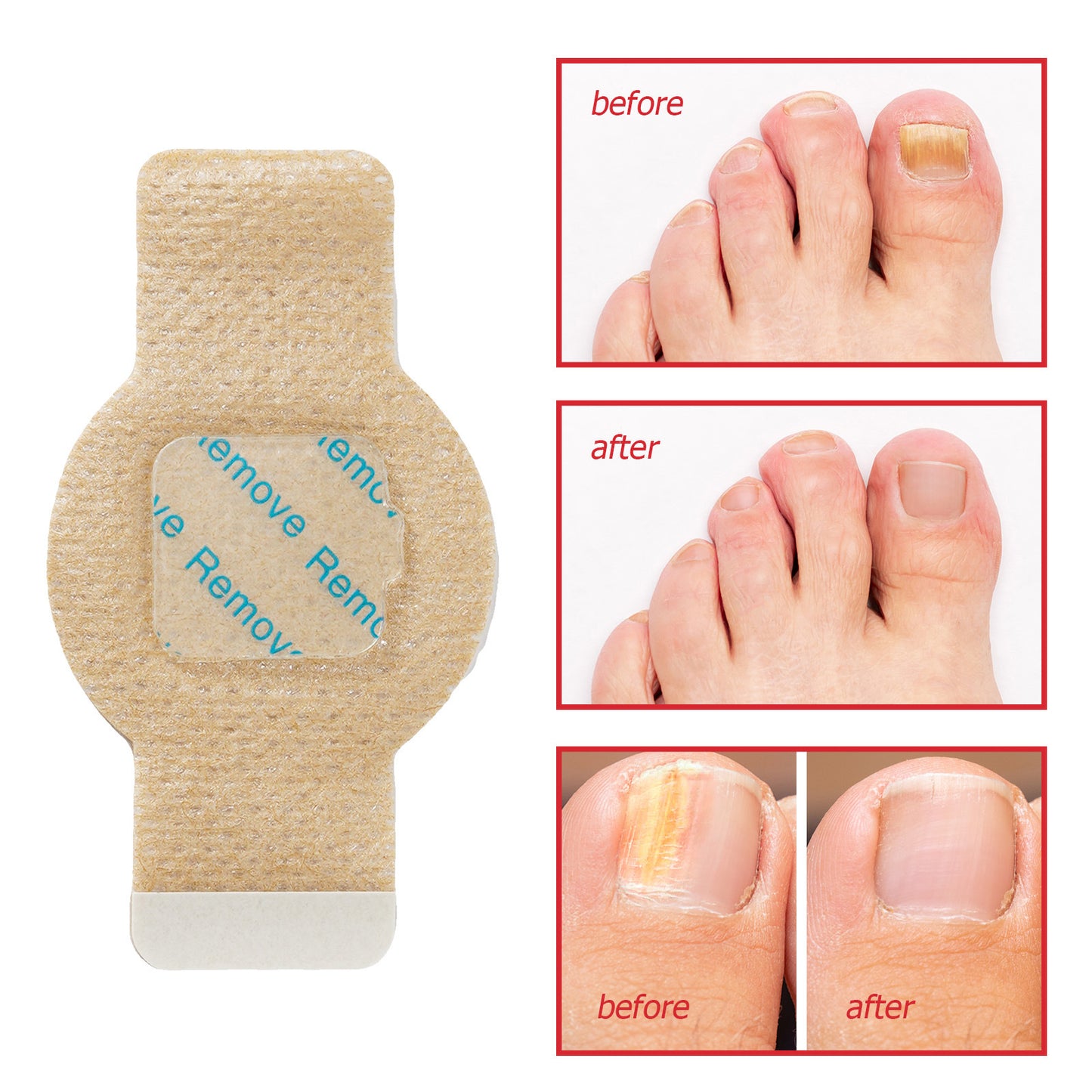 Fungal Nail Renew Patches