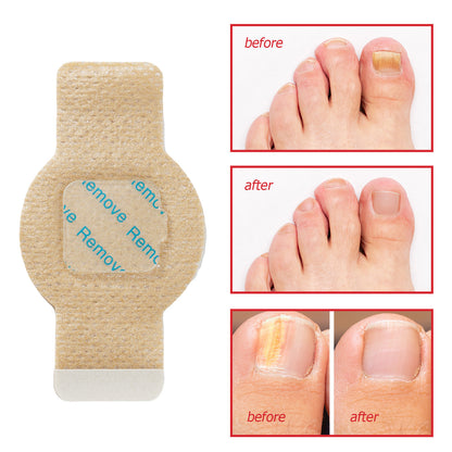 Fungal Nail Renew Patches
