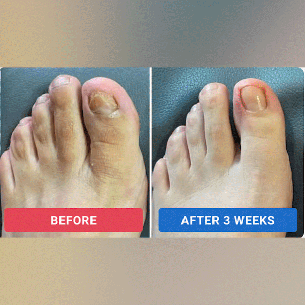 Fungal Nail Renew Patches